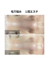 ヒール(heal)/毛穴悩み