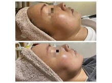 レモンボトルを2回施術されましたお客様の変化です