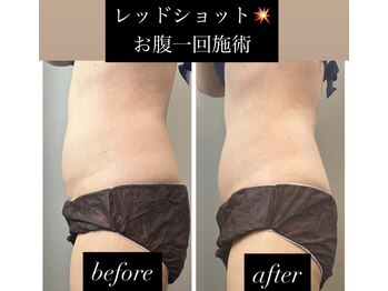 チャルム(CAL'ME)/レッドショット 下腹