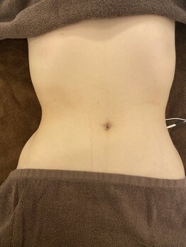 バストアップ・痩身・小顔専門サロン鈴鹿店 more【モア】腸マッサージ/膣トレの写真/結果重視◎皮下脂肪×固太り×セル脂肪にアプローチする痩身技術でわがままBodyにしっかりアプローチ★