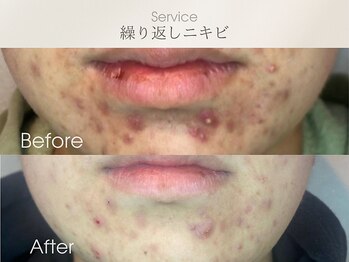 フェイシャルサロン ベルダ(BELDA)/【ニキビケアBefore After 】