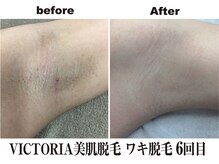 マイン イオンモール浜松市野店/速くて痛みが少ない美肌脱毛！
