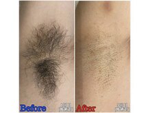 ファビー(Fabby)/メンズ脱毛☆ワキのビフォアフ