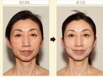 ニュイブラーシュ(nuit blanche)/REVIハーブピーリングで若さを