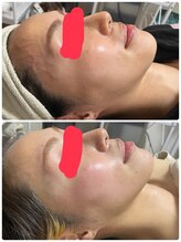 ビューティーホームサロン(Beauty Home Salon)/スピードハーブピーリング