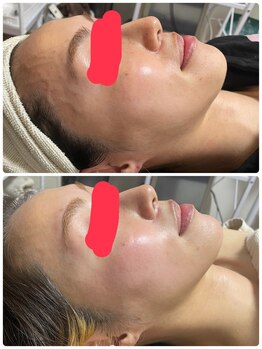 ビューティーホームサロン(Beauty Home Salon)/スピードハーブピーリング