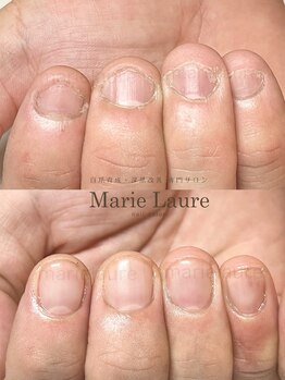 マリーロール 梅田店(Marie Laure)/自爪育成/深爪矯正/ネイルケア