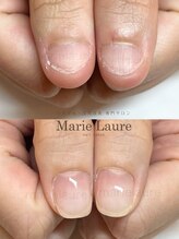 マリーロール 梅田店(Marie Laure)/深爪矯正/自爪育成/自爪風
