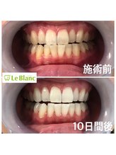 ルブラン 奈良店(Le Blanc)/縛りのないコースで確実に白く