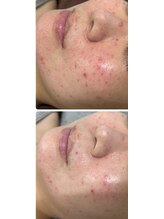 チュチュ(TUTU)/肌質改善５日間の変化