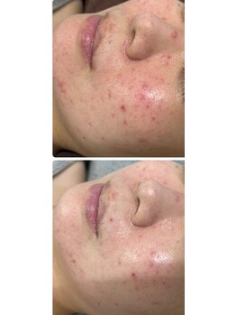 チュチュ(TUTU)/肌質改善５日間の変化