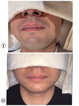 クサカンムリ(KUSAKANMURI)/男性ヒゲ1