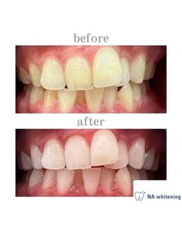 NA ホワイトニング 川崎溝の口店/ホワイトニング/川崎/溝の口