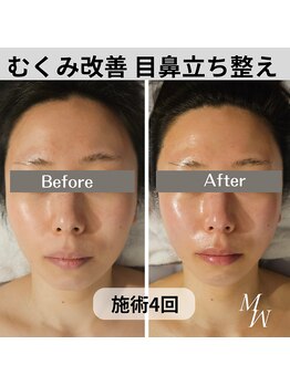 ミピマム 横浜駅前店/目鼻立ちも整う　Before After