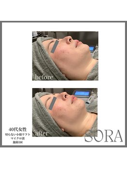 ソラ 天神 大名(SORA)/切らないリフト1回60kj