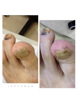 ドクターネイル爪革命 江戸川橋店/切りずらくなった爪のトラブル