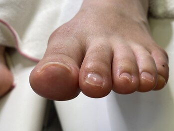 ツメフラ法　ご卒業