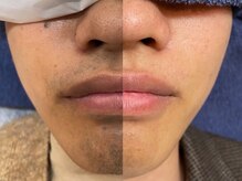 メンズオーシャンブルー/ヒゲ症例4