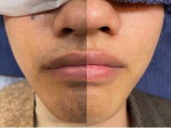 メンズオーシャンブルー/ヒゲ症例4