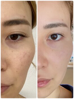 木の葉/若よもぎ蒸し（美・オーダーA）