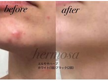ルリミ(Relimi)/ハーブピーリング　Before After