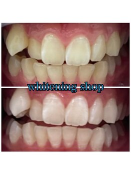 ホワイトニングショップ 刈谷店/Before&After美白ホワイトニング