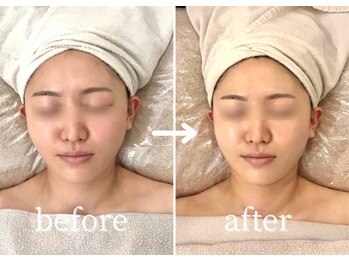 ボーレーヴ(beau reve)/小顔/リフトアップ/フェイシャル