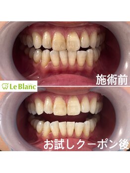 ルブラン 奈良店(Le Blanc)/歯！大事にして下さい！