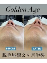 ゴールデンエイジ(Golden Age)/【ヒゲ脱毛】Before＆After
