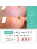 《ニキビケアハーブピーリング》剥離なし/ニキビケア/角質ケア/赤み改善