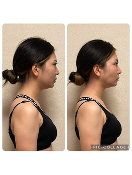 ニアベル(Nia Belle)/首悩み＋フェイスライン解消