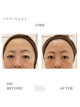 サロン エイトミー(salon 83)/ハイパージェット/before→after