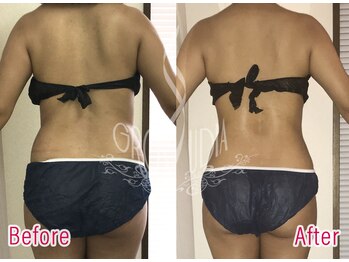 グラウディア 恵比寿/痩身/筋膜リリース/インディバ超