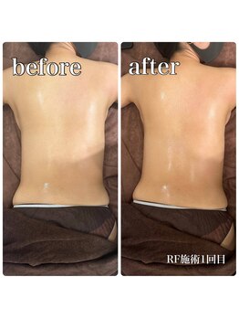 サロンドルクリア(Salon de LUCULIA)/エステ＃ラジオ波脂肪燃焼コース