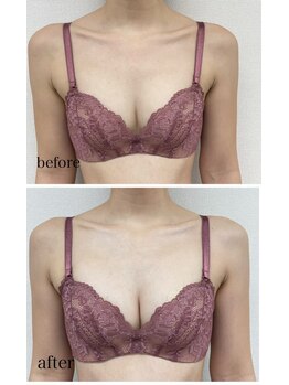 ルミエール(Lumiere)/【倉敷市】バストアップ施術事例