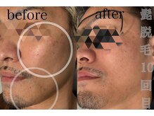 リツイート(ReTweet)/髭脱毛　脱毛＋美肌ケア