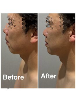 リレイスフクオカ(RelaceFUKUOKA)/脂肪分解