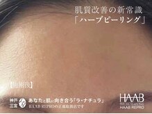 ラ ナチュラ(La natura)/HAABREPRO(ハーブピーリング)