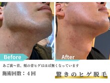 トレース/ヒゲ脱毛の効果