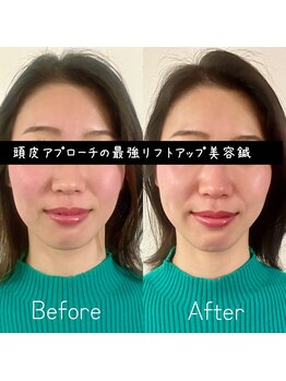 ヘッドサイエンス(HEADSCIENCE)/最強リフトアップ美容鍼