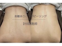 ヒジ(Life Salon)/ハーブピーリング/毛穴洗浄