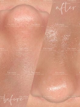 キスミー(Ksmiii)/毛穴洗浄