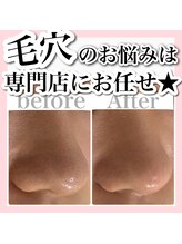 アルムダアクア 天王寺店(Aleumda AQUA)/大阪/天王寺/ハーブピーリング