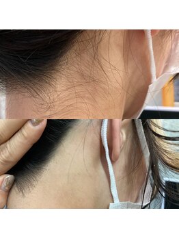 リエル(Reyel)/襟足脱毛　剃毛付★