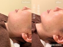 ウォーム(warm)/【国内最新】毛穴洗浄/小顔/岡山