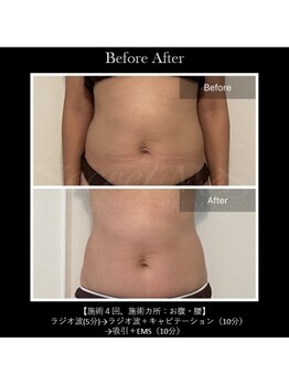 サロンドベル(salon de Belle)/集中痩身