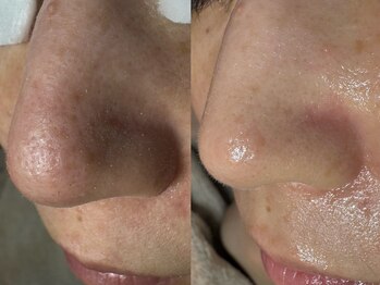 サラグランデ(Sara Grande)/毛穴の悩み改善!