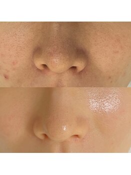 リフロ(Rifuro)の写真/ハリとつやのある水光肌へ！肌管理で毛穴レスな透明感を目指す根本改善サロン☆
