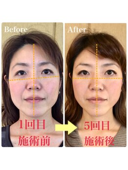 美容整体専門院 新美選/3D小顔矯正 変化写真