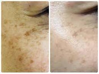 ニュイブラーシュ(nuit blanche)/REVIハーブピーリングでシミ改善